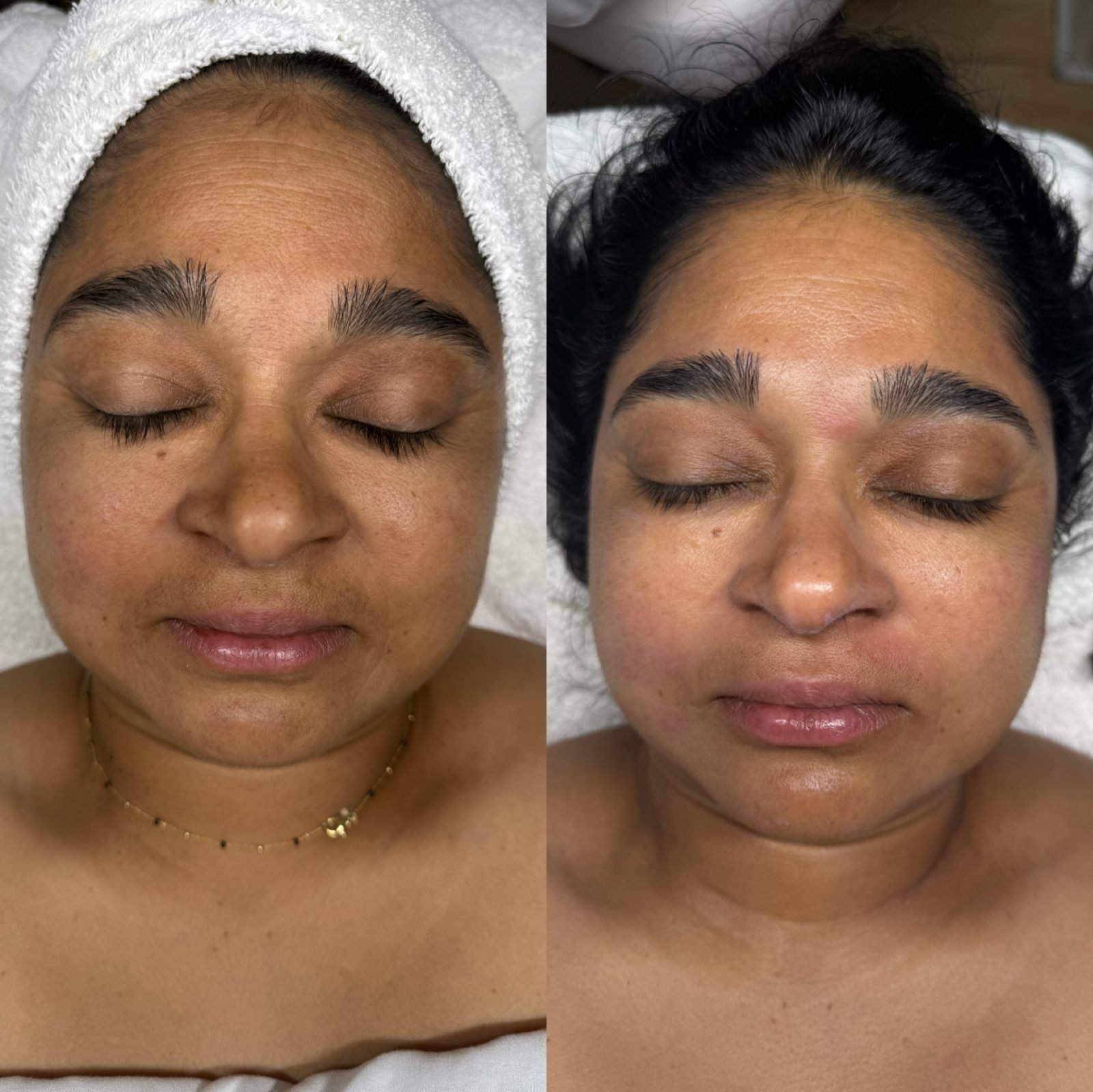 Facial before after
